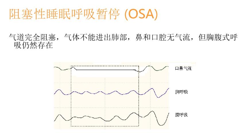 睡眠呼吸暂停